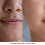 Try this if you want to clear skin and a fair complexion.