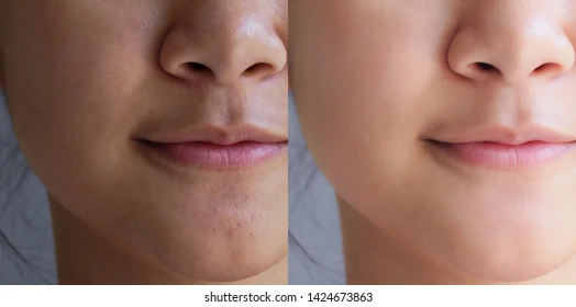 Try this if you want to clear skin and a fair complexion.