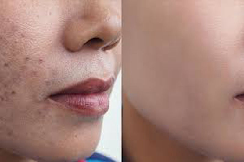 Home remedy to remove facial spots from the root.