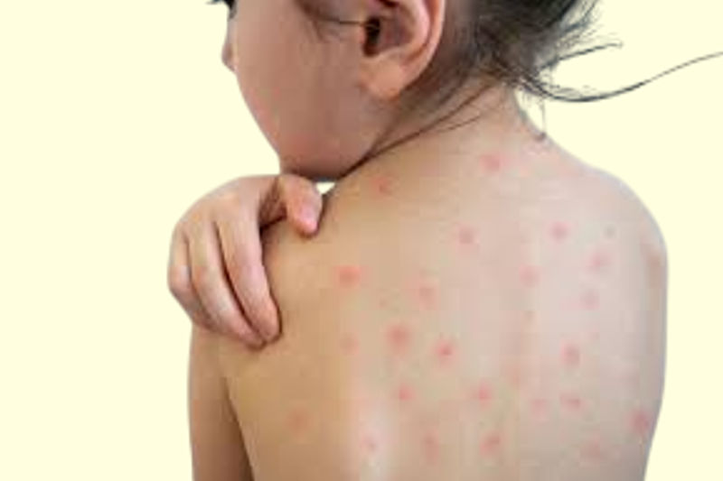 What Diet Is Best for Measles? Nutritional Guide for Faster Recovery.