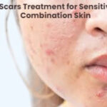 How to Get Rid of Acne Scars and Hyperpigmentation for Sensitive and Combination Skin with Natural Remedies
