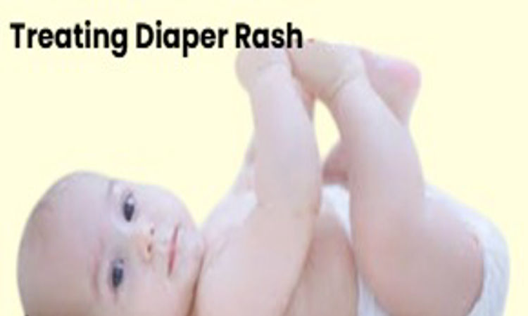 Tips for Treating Diaper Rash.