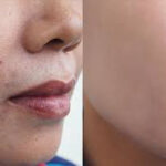 How can I eliminate my acne in a single day?