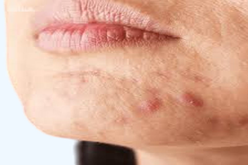 Is Applying Toothpaste to Pimples Effective for Acne? The Real Story.