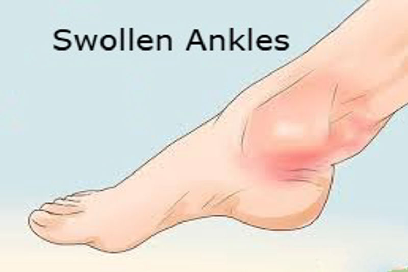 How to Reduce Swollen Ankles Quickly: 10 Home Remedies That Work.