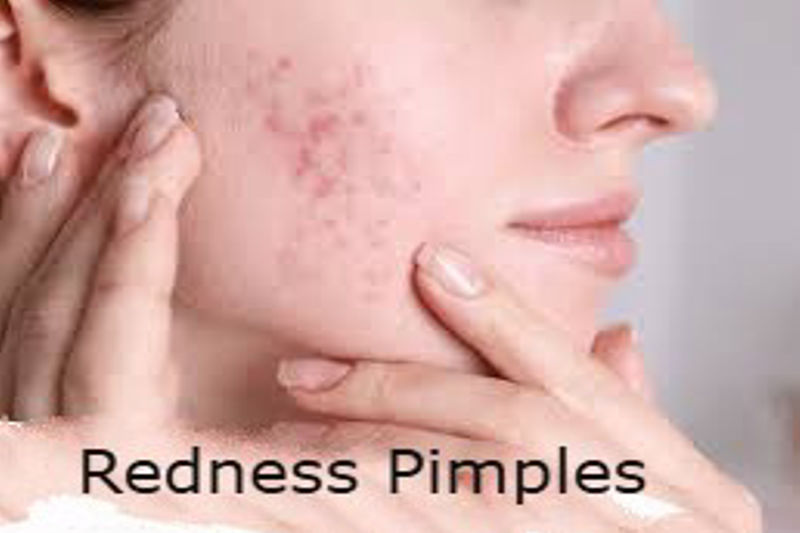 How to Get Rid of Redness from Pimples and Acne: Effective Remedies & Prevention Tips.