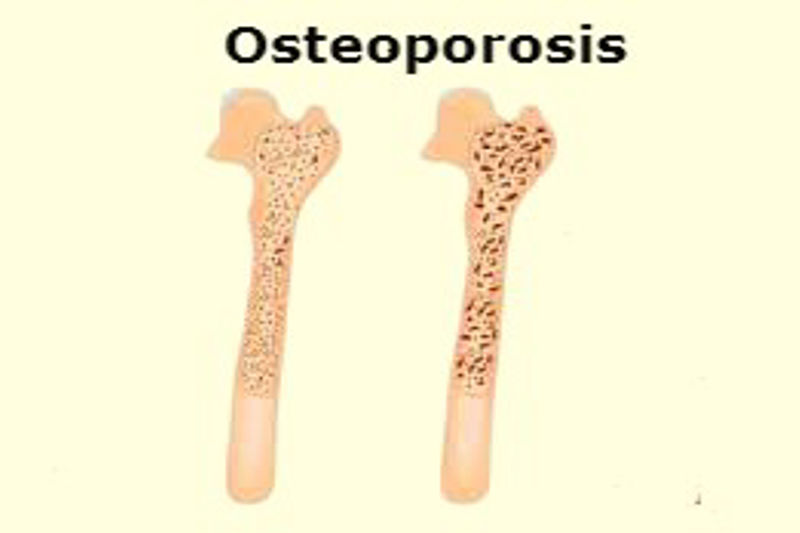 What is Osteoporosis? Causes, Symptoms, and Treatment