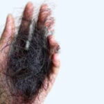 Hair Loss Types, Symptoms, Causes and Treatment.