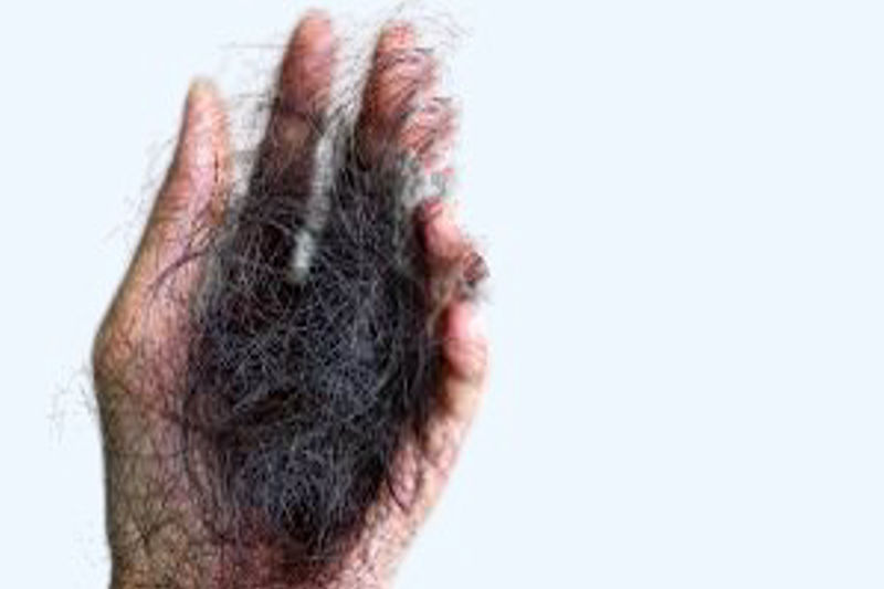 Hair Loss Types, Symptoms, Causes and Treatment.