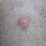 What is skin cancer?