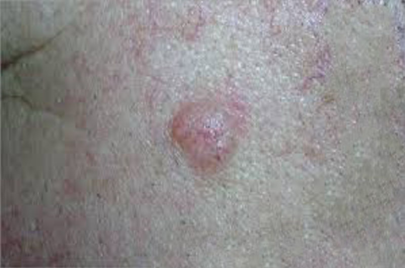 What is skin cancer?